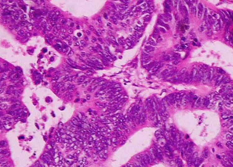 Radiofrequency ablation of hepatic metastases in colorectal cancer linked with improved survival