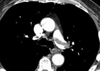 High rates of over-diagnosis of pulmonary embolism by CT angiography