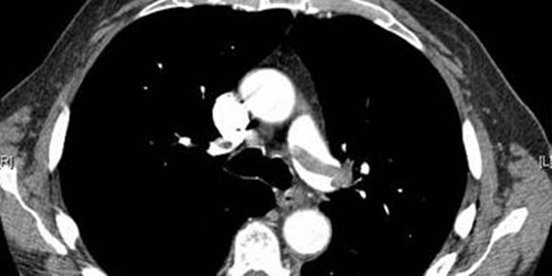 Pulmonary Embolism In Pregnant Women