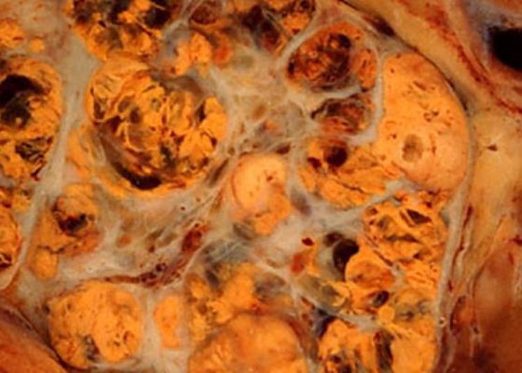 Radiographic surrogates may predict tumor-specific survival in renal carcinoma