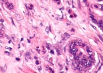 Development of a risk index for colorectal cancer screening