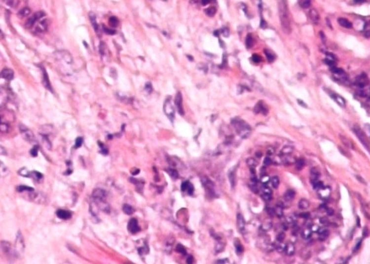 Development of a risk index for colorectal cancer screening