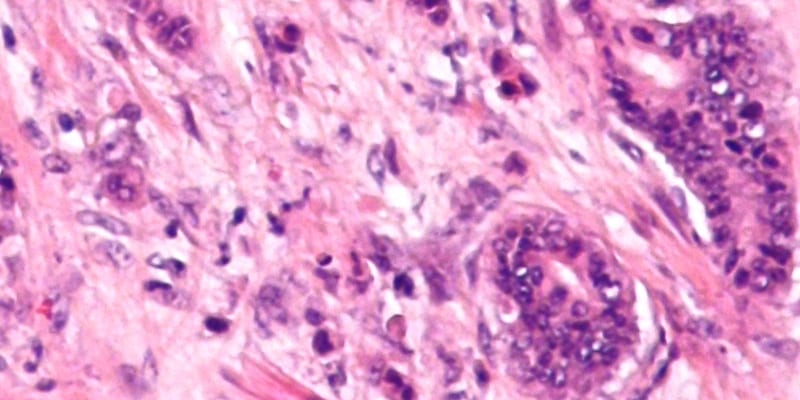 coloncancer2