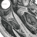 Image-guided percutaneous drainage of pericardial effusions is safe and effective