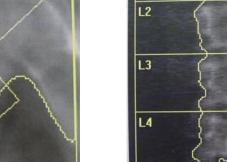 Vitamin D supplementation amongst post-menopausal women did not improve functional outcomes