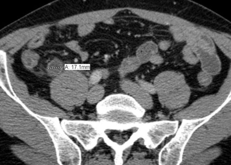 CT findings independently predict costs associated with acute appendicitis