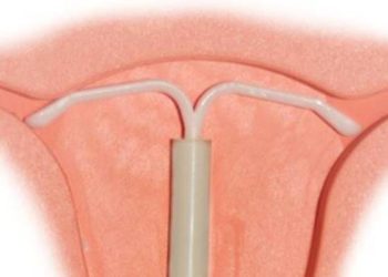 Lower long-term IUD use among young women