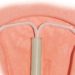 Lower long-term IUD use among young women