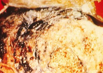 Severity of emphysema on pulmonary CT may predict lung cancer location