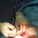 No differences in pain between suture and staple C-Section closure