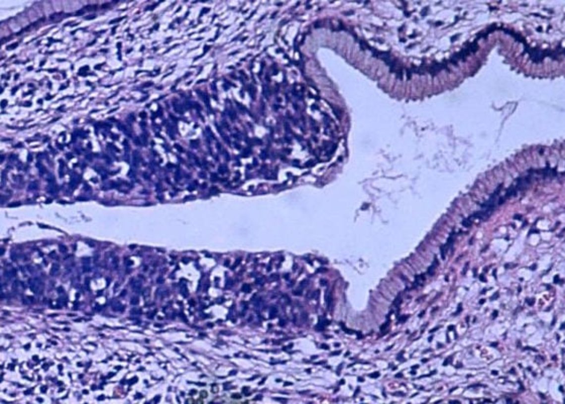 Cervical intraepithelial neoplasia grade 2 and risk of preterm birth ...