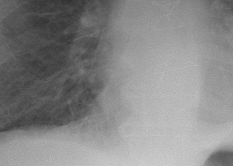 CHADS-VASc score may help predict outcomes in heart failure