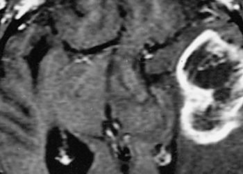 Glioblastoma phenotypes identified on MRI predict molecular behavior