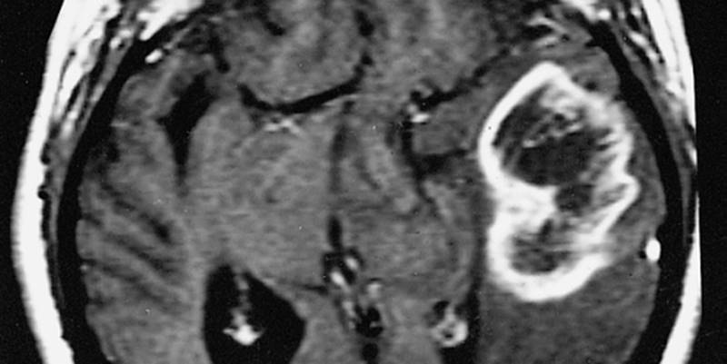 glioblastoma_mult2_edited