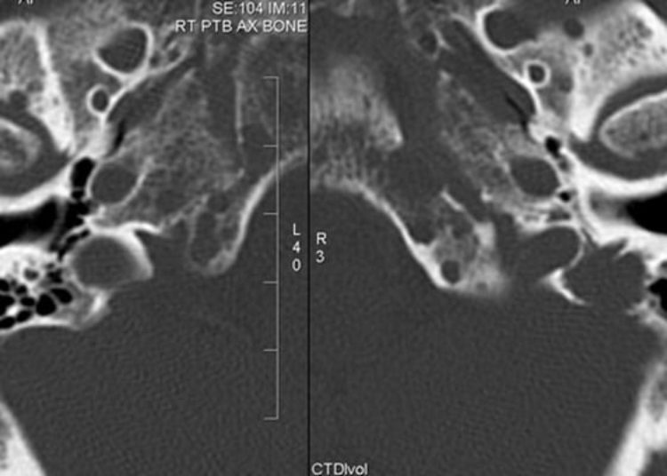 Targeted autologous transfusion may aid advanced refractory multiple myeloma