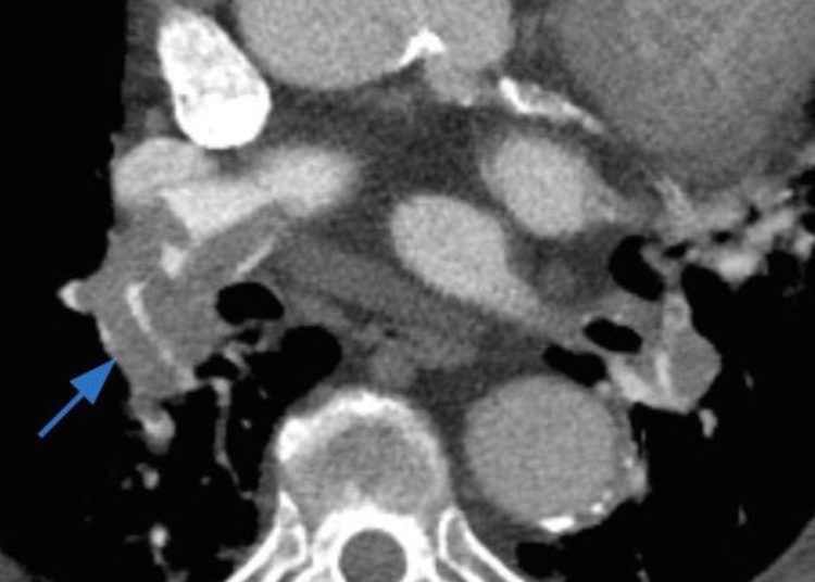 ACP releases practice guidelines for the evaluation of suspected acute pulmonary embolism
