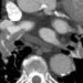 ACP releases practice guidelines for the evaluation of suspected acute pulmonary embolism