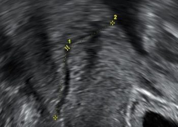 Cervical length at term helps predict delivery date