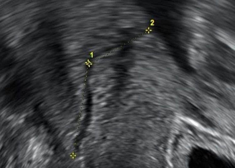 Cervical length at term helps predict delivery date