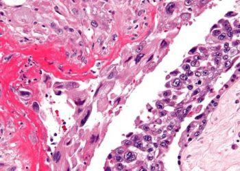 FIGO score ≥13 associated with early gestational trophoblastic disease death