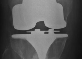 Total knee replacement with post-surgical regimen yields greater relief vs nonsurgical treatment alone