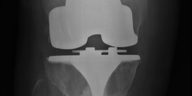 Right_Knee_Post-surgery_frontal_implant