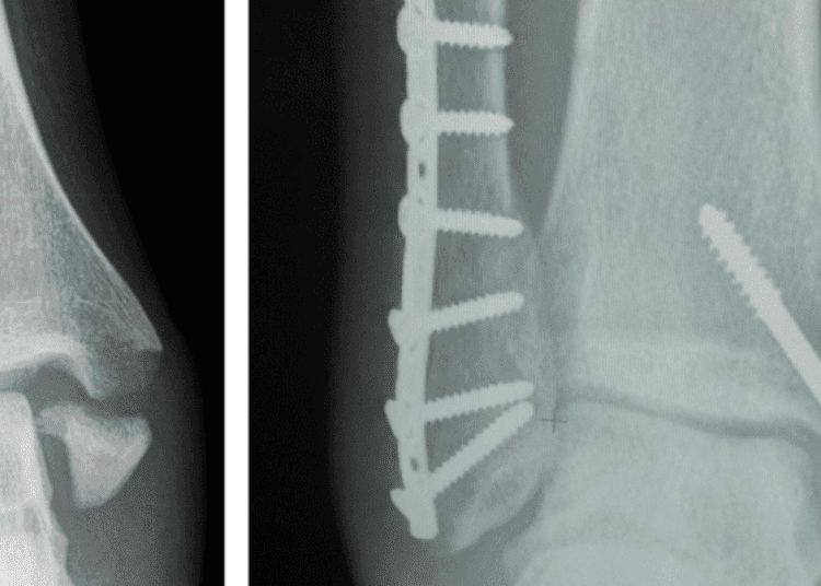 Rehabilitation after immobilization for ankle fracture: The EXACT trial