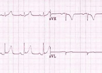 Early repolarization on ECG not associated with long-term prognosis
