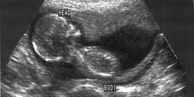 what is presentation in ultrasound