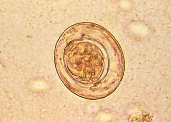 Neoplastic tapeworm cells may invade human tissue in immunocompromised hosts