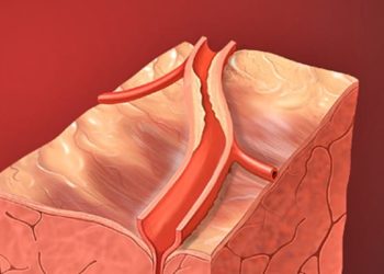 PCI not superior to medical therapy alone in stable coronary disease: The COURAGE study