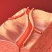 PCI not superior to medical therapy alone in stable coronary disease: The COURAGE study