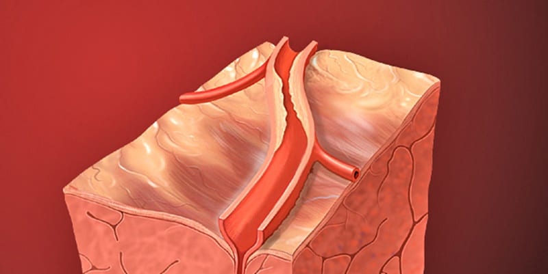 CC Patrick J. Lynch Coronary Artery Lesion