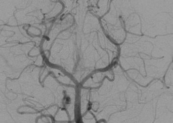 Interventional neuroradiology procedures may deliver lens radiation doses exceeding safe thresholds