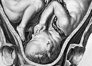 Increased severe maternal morbidity with multiple gestation pregnancies