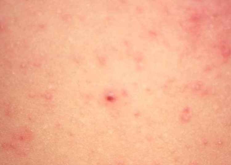 Mass administration of ivermectin may decrease prevalence of scabies and impetigo
