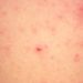 Mass administration of ivermectin may decrease prevalence of scabies and impetigo