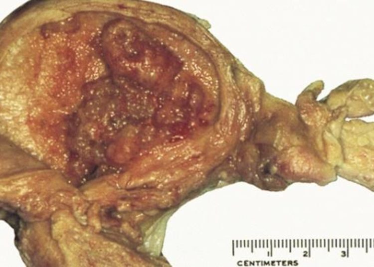 Recurrence of endometrial hyperplasia following medical therapy is common