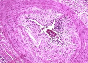 Selexipag may decrease mortality related to pulmonary arterial hypertension: The GRIPHON study