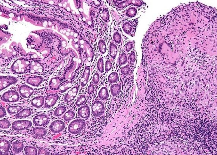 Anti-TNF therapy for inflammatory bowel disease may induce skin lesions