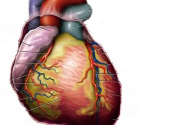 Radiation dose associated with increased heart disease in Hodgkin lymphoma survivors