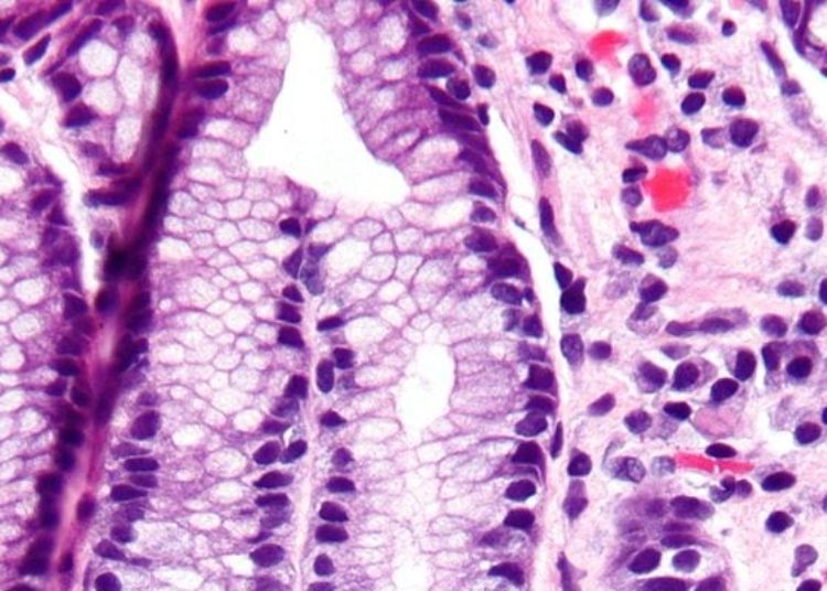 Proton pump inhibitor use associated with development of chronic kidney disease
