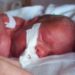 AAP addresses neonatal pain prevention