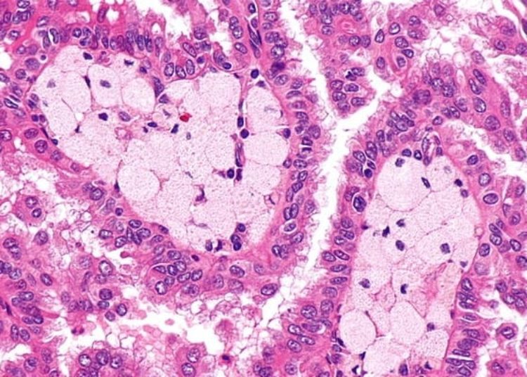 Galangin may sensitize apoptosis-resistant renal carcinoma cells [PreClinical]