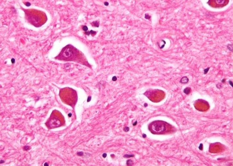 Genetic risk assessment for Alzheimer’s disease does not increase anxiety, depression or stress