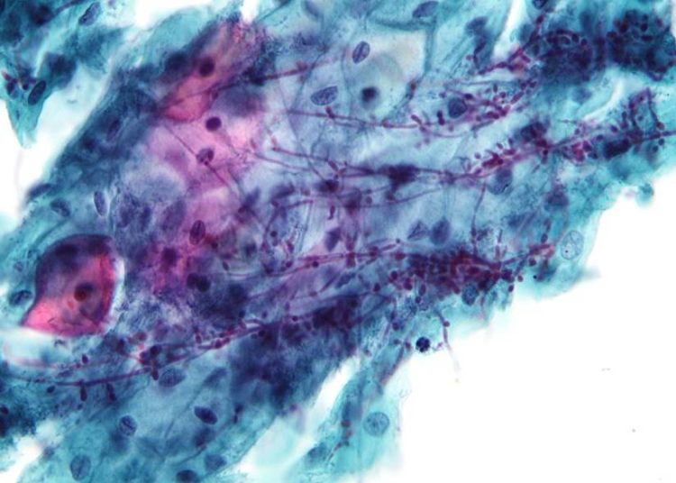 Oral fluconazole in pregnancy associated with miscarriage