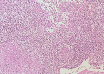 Sentinel lymph node mapping identifies metastases in high-risk endometrial cancer