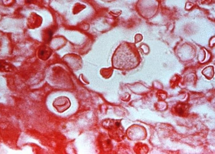 Adjunctive dexamethasone in HIV-cryptococcal meningitis linked with increased morbidity and mortality: The CryptoDex study