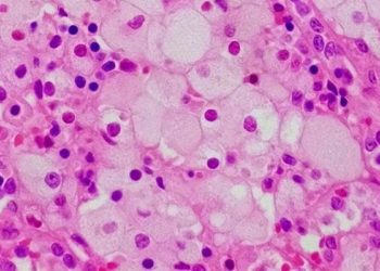 Drug reformulation may improve treatment of Niemann-Pick type C disease [PreClinical]