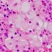 Drug reformulation may improve treatment of Niemann-Pick type C disease [PreClinical]